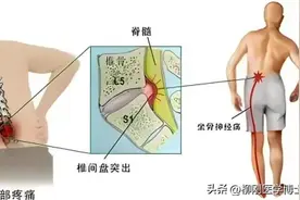 什么是腰椎间盘突出症？图片