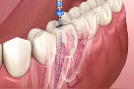 根管治疗后牙疼的三大原因！你了解吗？图片