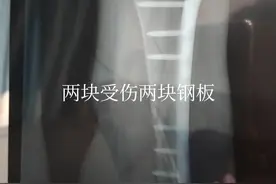 同腿连续两年两次伤骨折手术的身心磨难！图片