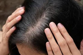 头皮上摸到小疙瘩和脓包，或是5种疾病信号，别不当回事！图片