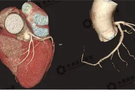 一文读懂什么是冠状动脉CTA检查图片