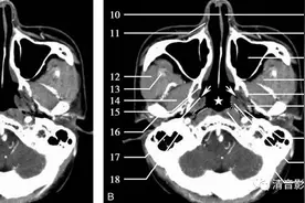 颈部CT解剖图片