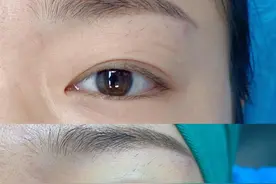 想割双眼皮，要多少钱？医保能报吗？快来看看！图片