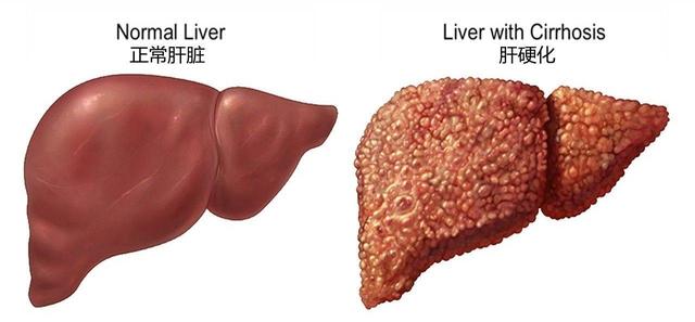医生研究发现：一旦患上肝硬化，吃饭一定要注意三点，别不当回事