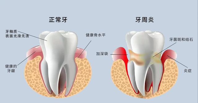 寿命长不长，牙齿先知？65岁后，掉牙多的人活得久？告诉你答案