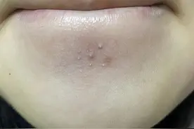 肝病到来脸部先知？医生提醒：肝脏不好的人，脸上会有这4个表现图片
