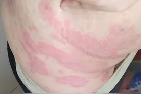 多发性红斑图片