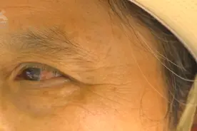 林阿姨眼部受伤、缝了4针，竟是这种小朋友常玩的东西惹的祸！图片