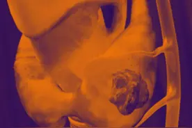 2亿人都有的结节，查出甲状腺结节就得手术吗？图片