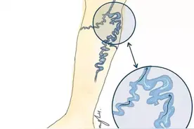 静脉曲张坚持穿弹力袜，可以不用做手术吗？看看血管外科医生科普图片