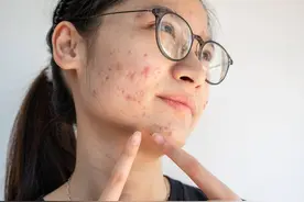 痘痘频发惹人烦！中医析！内调外治让你肌肤恢复光滑图片