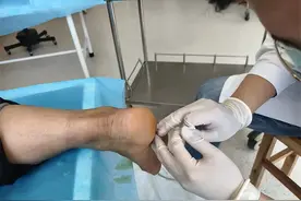 跟骨骨刺疼痛难忍 济南市莱芜人民医院小针刀治疗5分钟奏效图片