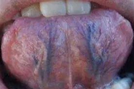 舌下青筋发黑，就应该活血化瘀？大错特错！教你一招，对症调理。图片