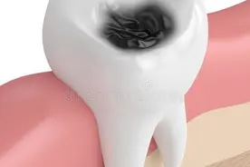 牙齿有洞，能自己恢复吗？买材料自己补行不行？图片