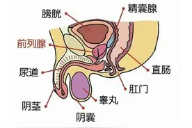 体检发现前列腺钙化，怎么办？图片