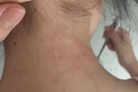 被隐翅虫的体液沾到（内有可能引起不适的图片，请慎打开）图片