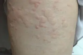 太惨了！出门一趟，福建一姑娘身上密密麻麻全是…近期高温，已有多人中招！图片