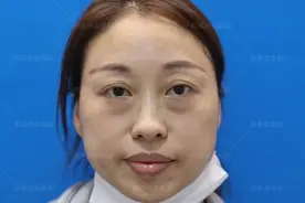 41岁谈第一次眼袋手术经历：亲妹妹介绍的，没想过术后会成这样图片