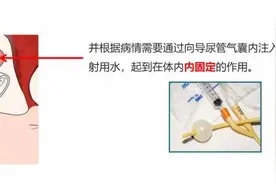 居家照护科普系列——别让尿管成“负担”，居家护理看过来！图片
