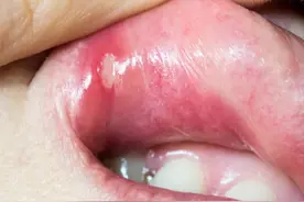 艾灸伤阴是咋回事？很多人还傻傻不清楚图片