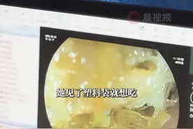 18岁少女胃里取出整整2斤塑料袋，已经臭了！持续6年，根本控制不住图片