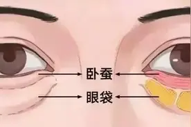 为什么年轻人会出现泪沟？王耀聪院长教你如何消除泪沟图片