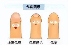 暑期迎来小儿“割包皮热”！关于割包皮你需要知道这几点图片