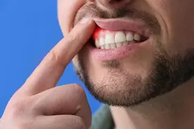 牙龈上火肿痛怎么办？教你快速消肿止痛图片