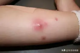 这种“痘”千万别挤！严重可引起全身感染图片