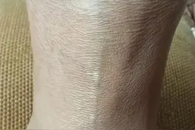 脚踝骨折166天康复记图片