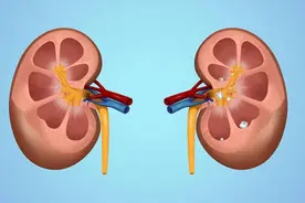 肾结石病人应如何调节饮食？图片