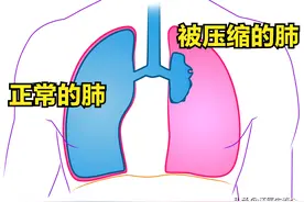 气胸是什么，危险吗？图片