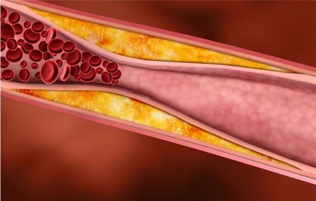 花生是高血压“催化剂”?提醒:若不想血压失控	，远离“1白2黄	”