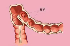肠息肉会不会再长，取决于3个条件，早解决早受益图片