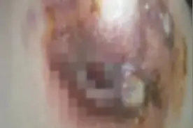 肉芽肿乳腺炎，化脓破溃不适合这一操作！徒增痛苦图片