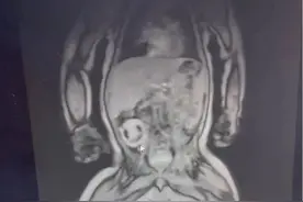 极为罕见！新生儿睾丸内有个“胎体”，还在不停游移图片