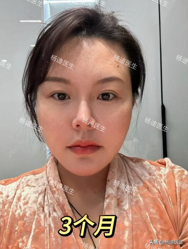 花4.5万做面部提升，闺蜜却说“整容脸”！真的有那么假吗？
