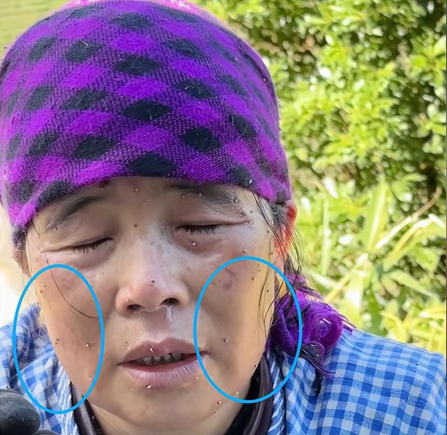云南大姨被蜜蜂狂蜇，满脸蜂刺求助，过路司机惊呆，网友直呼惊险