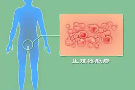生殖器疱疹会导致“私密部位”不适？这3个表现，男女都应该记住图片