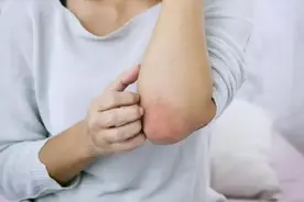 血脂高不高，皮肤知道？若出现这2种症状，高血脂可能已经盯上你图片