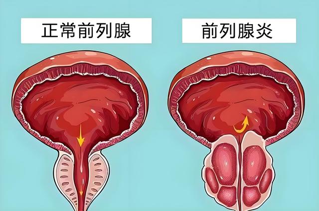 前列腺有病，小便先知，注意6种异常表现，或是前列腺肥大的信号