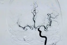 脑血管造影真的那么恐怖吗？会不会把人做瘫？图片