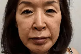 53岁老太太的自述：做完眼周筋膜提升2年后，这些经历分享给大家图片