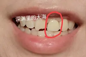 历经十个半月，种植牙终于安装完成了图片
