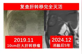 3位肝转移患者的治疗：如何迈过5年这个坎图片