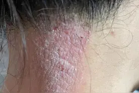 神经性皮炎的发作过程，都是这样“作”出来的。图片