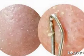 脸上挤出来“白色条状物”是什么东西？有办法去除吗图片