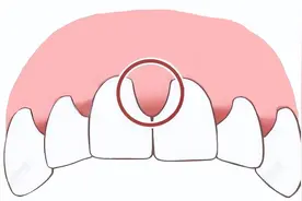 牙龈增生的原因和治疗方法图片