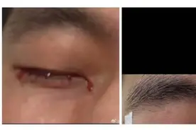 郭艾伦自曝结膜裂伤，已紧急手术！会影响视力吗？眼科医生这样说图片