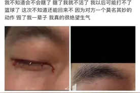 郭艾伦自曝结膜裂伤，已紧急手术！会影响视力吗？眼科医生这样说图片